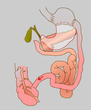 Bilio Pancreatic Diversion