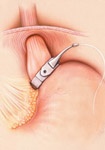 lapband surgery