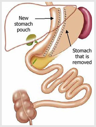 Sleeve Gastrectomy